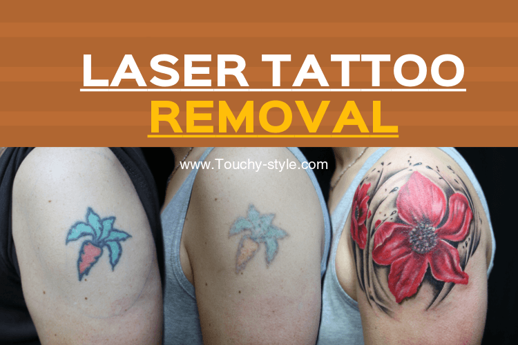 Laser Tattoo Removal - Touchy Style .